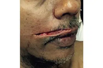 MANGSA SERANGAN: Pekerja Victory Restaurant, Encik Liakath Ali, mengalami kecederaan serius sehingga mengalami kecacatan kekal di wajahnya, menyusuli serangan pada 26 Ogos lalu di Arab Street. - Foto CHAIRUL FAHMY HUSSAINI