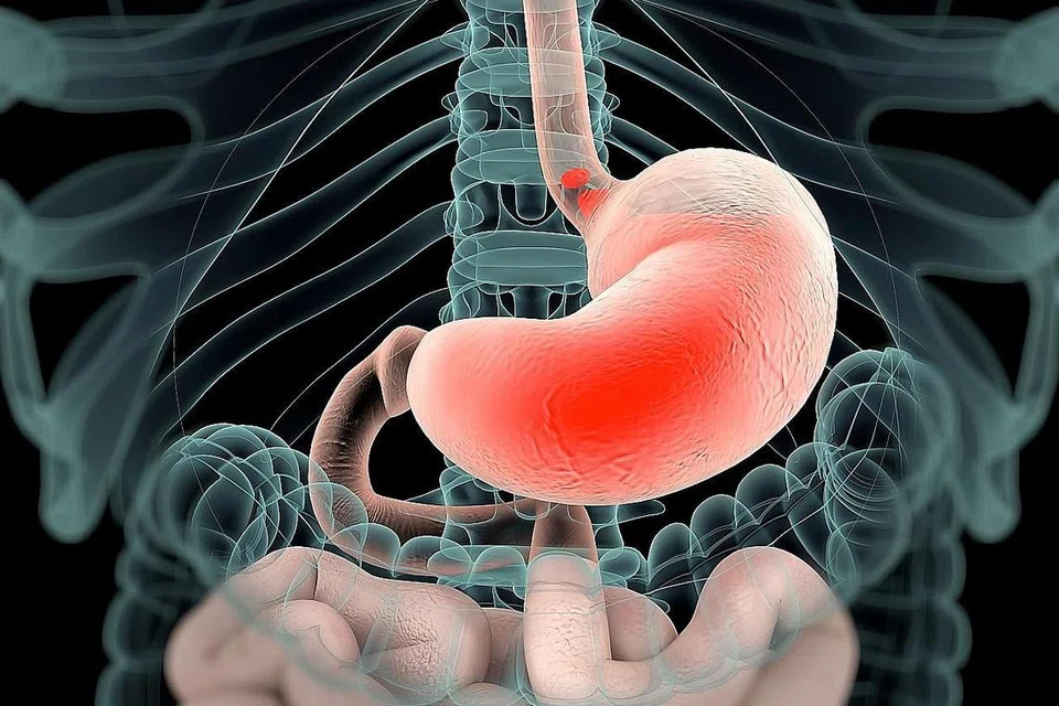 GERD: Gambaran apabila pedih hulu hati berlaku sebagaimana yang ditunjukkan pada imbasan dalam usus. Perut berwarna merah. - Foto ISTOCKPHOTO