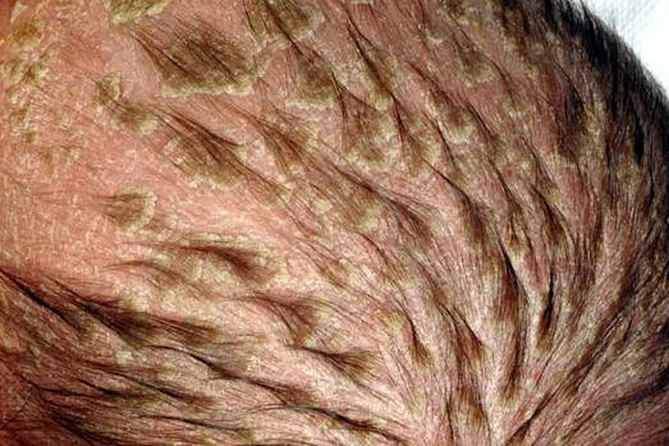 KESAN PADA KULIT: Inilah antara kesan akibat dermatitis kontak yang dialami pesakit yang menghidap ekzima itu. - Foto NHG 