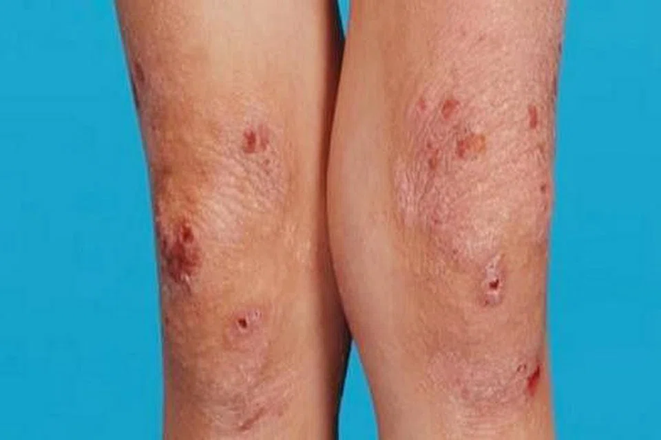 MUDAH TERDEDAH: Ekzima atopik dikaitkan dengan pesakit yang menghidap ruam gatal di kawasan kulit yang terlipat terutamanya di siku, belakang lutut dan tengkuk. - Foto NHG 