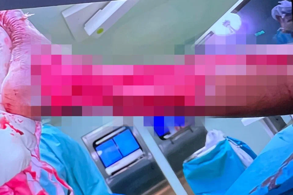 (Amaran: Sesetengah pembaca mungkin terganggu dengan imej berikut) Daging pada kaki kanan Encik Amjath terpaksa dikeluarkan untuk menghindar kuman dari merebak.