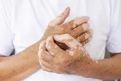 vitiligo, sopak