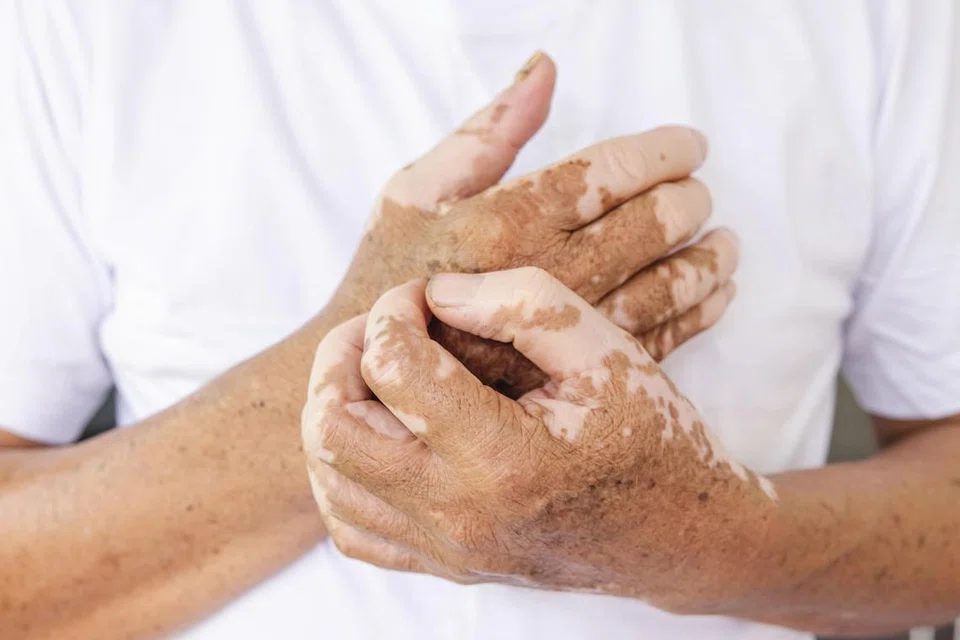 vitiligo, sopak