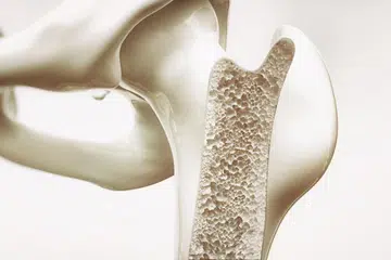 osteoporosis, tulang, kesihatan