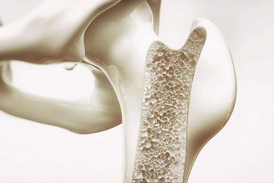 osteoporosis, tulang, kesihatan