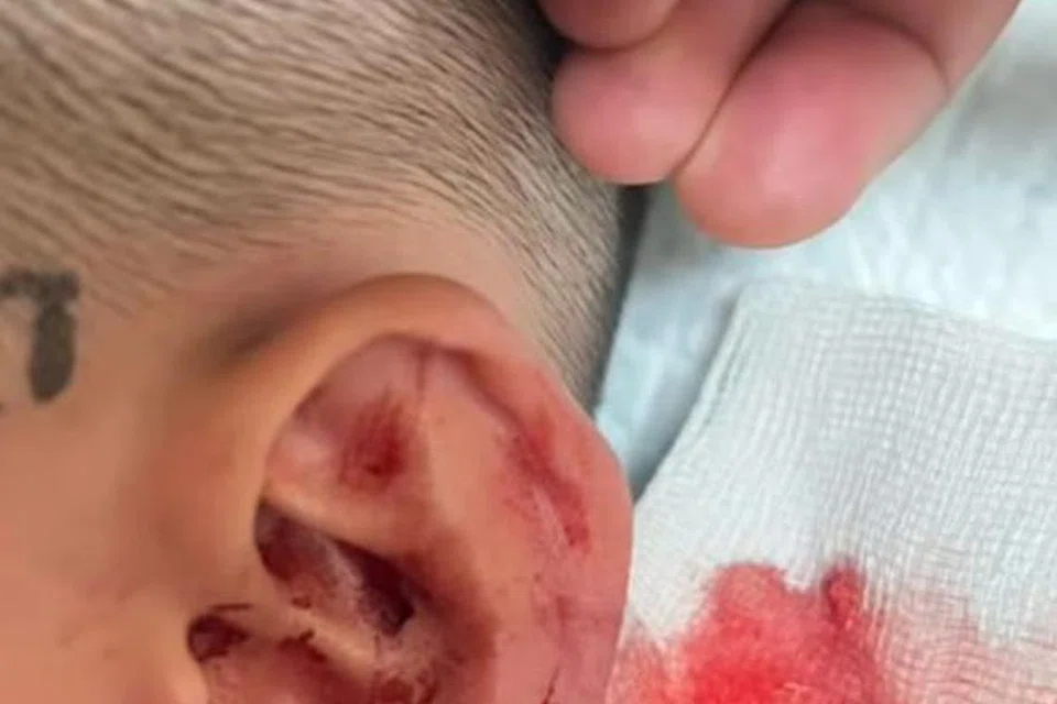 Sebahagian cuping telinga seorang kanak-kanak berusia enam tahun putus akibat digigit seekor kuda ketika mengunjungi sebuah ladang agro di Seremban, Negeri Sembilan, pada 19 Januari.