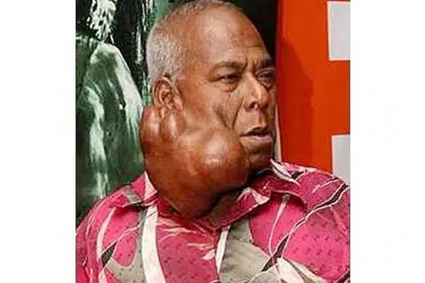 ALLAHYARHAM SIDEK HUSSAIN: Ketumbuhan pada pipinya menjadi barah, lalu meragut nyawanya. - Foto INTERNET