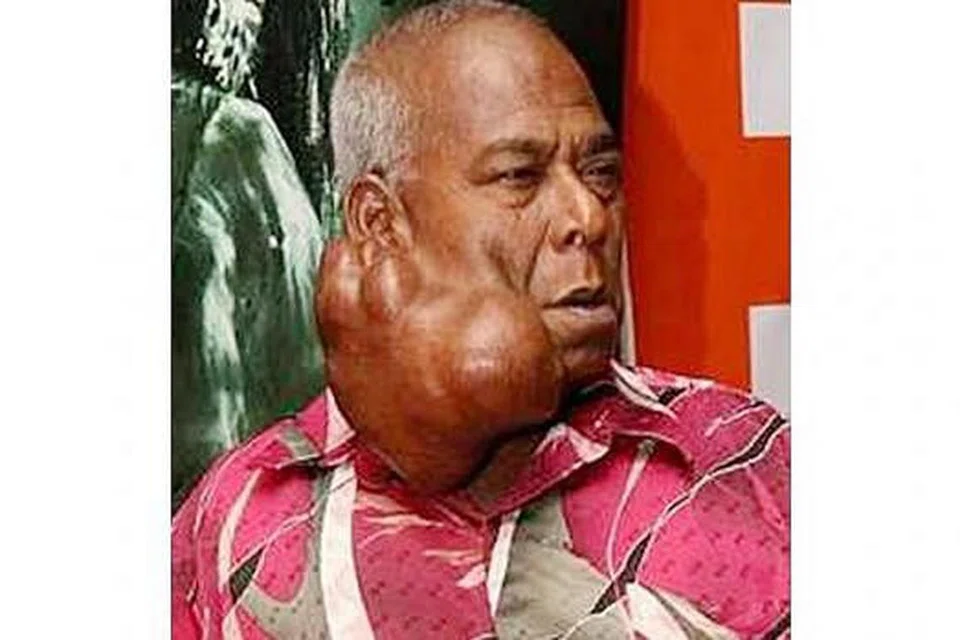 ALLAHYARHAM SIDEK HUSSAIN: Ketumbuhan pada pipinya menjadi barah, lalu meragut nyawanya. - Foto INTERNET