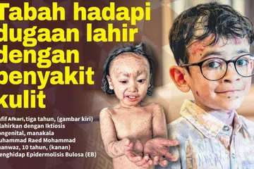 Rafif Afkari, tiga tahun, (gambar kiri) dilahirkan dengan Iktiosis Kongenital, manakala Muhammad Raed Mohammad Shanwaz, 10 tahun, (kanan) menghidap Epidermolisis Bulosa (EB).
