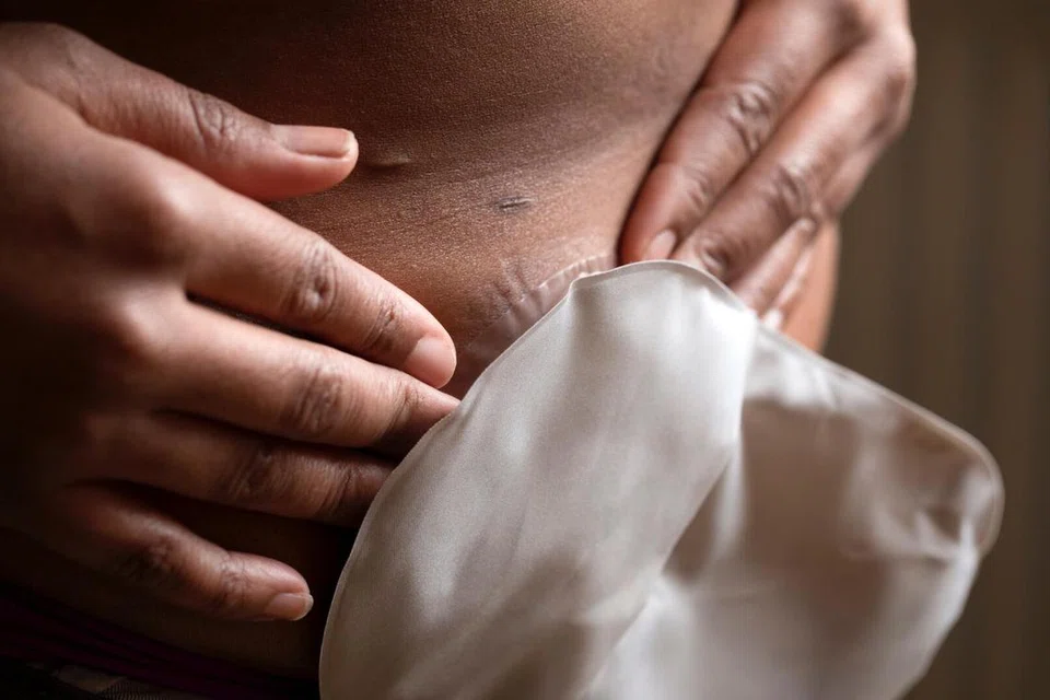 ‘Stoma’, satu tebukan yang dibuat melalui pembedahan, disambung pada beg ‘ostomy’ yang dipakai di bahagian luar badan, untuk mengumpul najis yang dikeluarkan badan. Beg tersebut perlu ditukar dari masa ke masa.