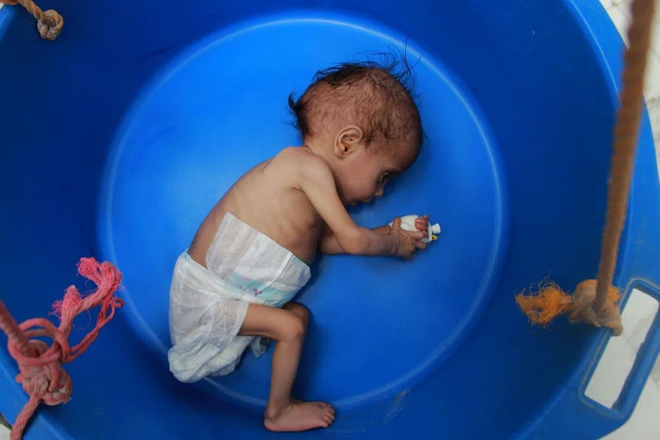 RUNDUNG SENGSARA: Gambar yang dirakamkan pada 5 Julai ini menunjukkan seorang bayi Yemen mengalami kekurangan zat dan sedang ditimbang berat badannya di wilayah Hajjah, utara Yemen. - Foto AFP 