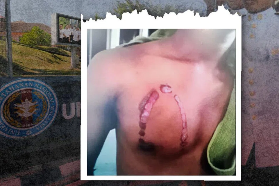 Kesan kecederaan di dada seorang penuntut Akademi Latihan Ketenteraan (ALK) Universiti Pertahanan Nasional Malaysia (UPNM) (gambar) akibat ditekap dengan seterika panas oleh pegawai kadet senior universiti itu baru-baru ini.