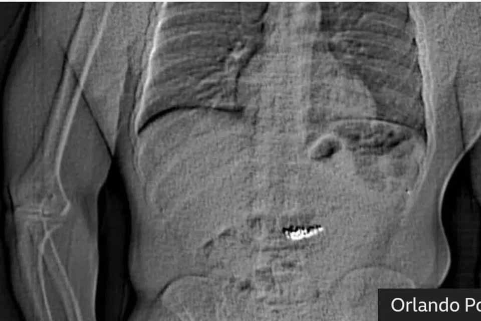 Polis Orlando telah mengeluarkan imej X-ray yang menunjukkan objek asing di dalam abdomen suspek.
