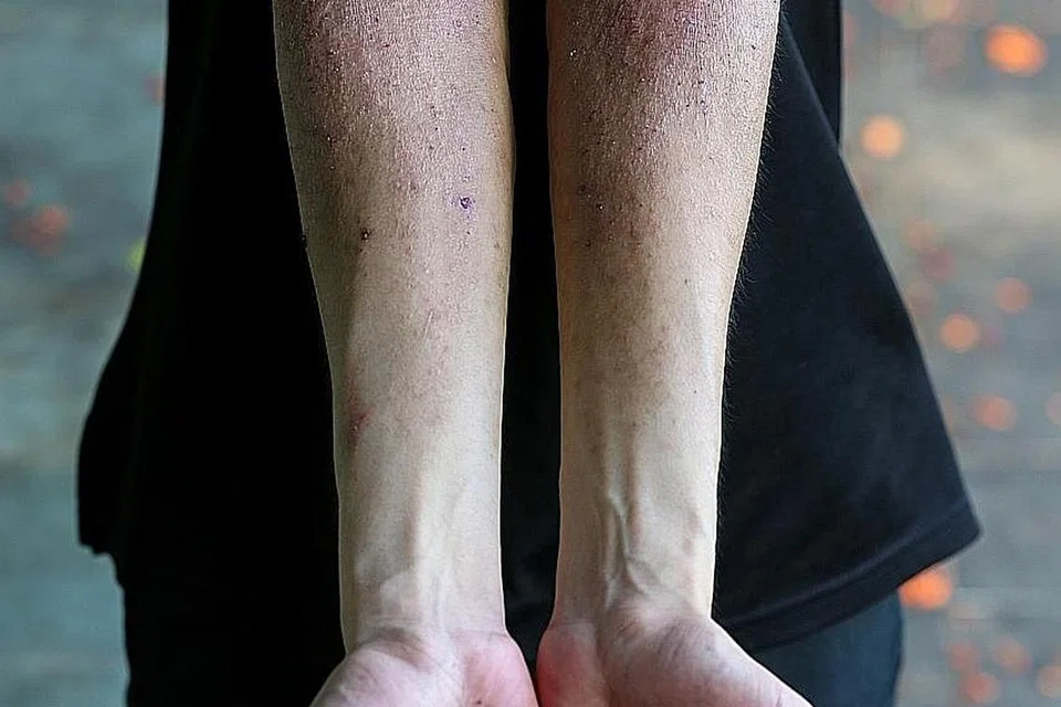 KES BERTAMBAH: Jumlah kes ekzema dilaporkan bertambah semasa pandemik, menurut NSC dan pakar dermatologi. - Foto fail