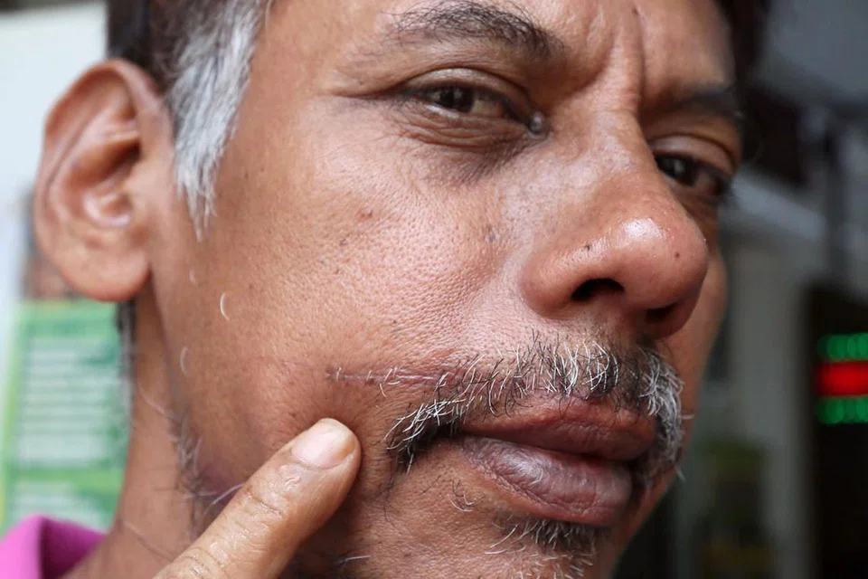 Encik Liakath mengalami luka dalam di hidung dan bibir dalam serangan tahun lalu, yang meninggalkan parut kekal. 