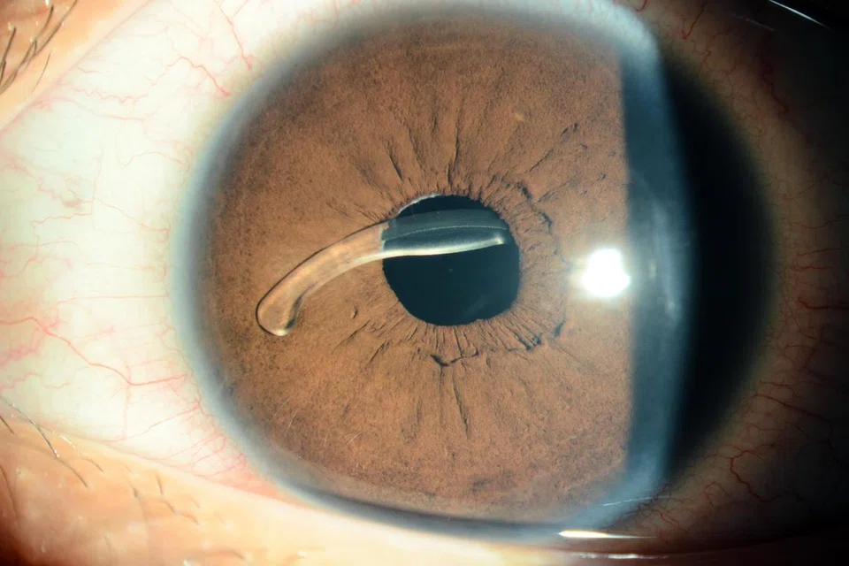 Mata seorang pesakit selepas pembedahan katarak, apabila kanta intraokular dimasukkan ke dalam mata untuk memulihkan penglihatan. Namun, dalam imej ini, kanta berganjak dari kedudukan asal. Pembedahan tambahan diperlukan untuk meletakkan semula kanta itu di belakang anak mata.