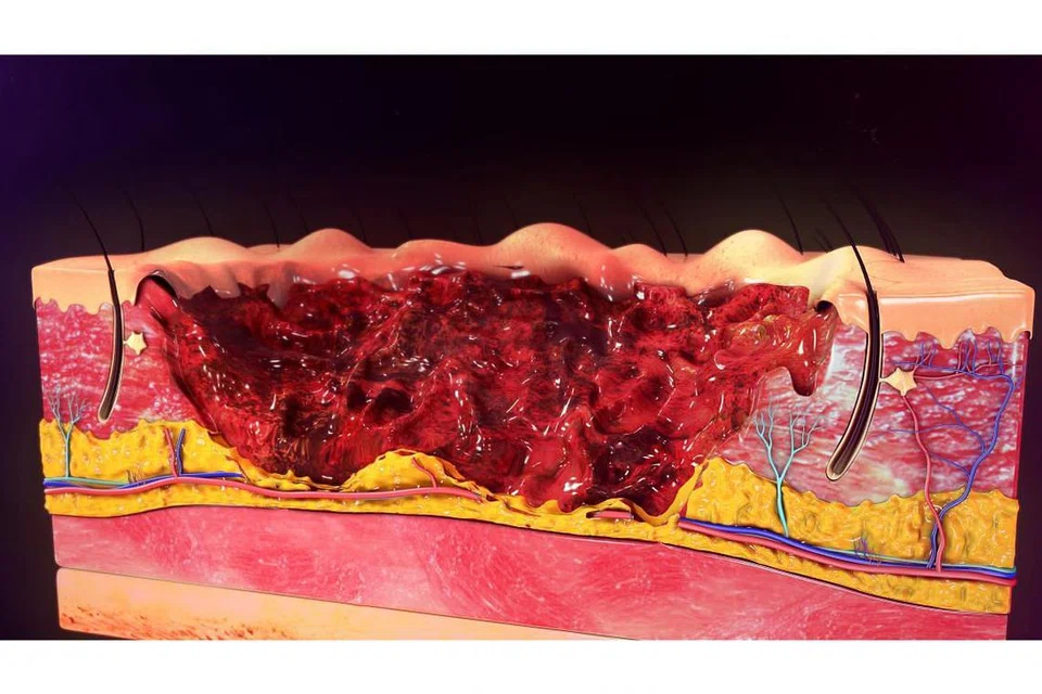KELECURAN TAHAP TIGA: Kecederaan yang dialami, antaranya, melibatkan lapisan kulit sehingga ke derma dan lapisan lemak, bahagian yang tercedera menjadi kering, luka mungkin mengalami pendarahan dan pesakit berasa sedikit sakit atau tidak berasa sakit akibat kerosakan saraf. - Foto ISTOCKPHOTO