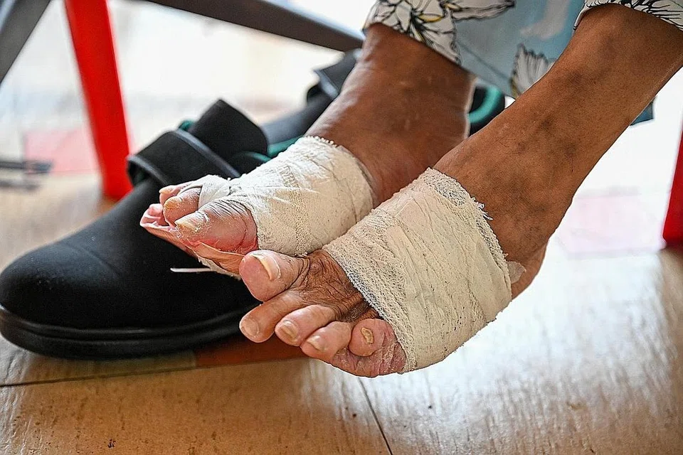 TERUS BERNIAGA: Walaupun perlu menahan sakit di bahagian kakinya akibat ulser kencing manis (gambar atas), Cik Siti Rahimah Edris tetap pergi ke gerai nasi padangnya di kedai kopi Blok 36, Chai Chee Avenue setiap hari untuk membantu memasak dan melayan pelanggan. Ini kerana beliau amat suka berniaga dan mahu membantu mereka yang kurang berkemampuan dengan menyediakan makanan pada harga yang murah dan berpatutan. - Foto-foto BM oleh SHAFIQ APANDI