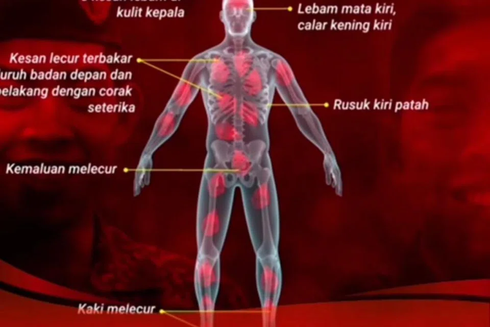 Lakaran grafik menunjukkan kesan kecederaan pada tubuh Pegawai Kadet Laut, Allahyarham Zulfarhan Osman Zulkarnain, yang meninggal dunia pada 1 Jun 2017, akibat dibuli dan didera dengan kejam menggunakan seterika dan beberapa objek lain oleh rakan di Universiti Pertahanan Nasional Malaysia (UPNM).