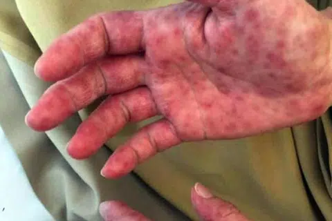 Penyakit tangan, kaki dan mulut (HFMD) ialah jangkitan yang menyebabkan ruam pada tangan dan kaki, serta ulser mulut.