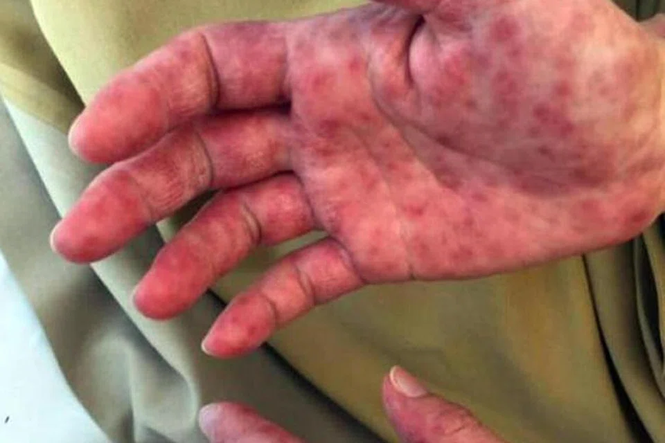 Penyakit tangan, kaki dan mulut (HFMD) ialah jangkitan yang menyebabkan ruam pada tangan dan kaki, serta ulser mulut.