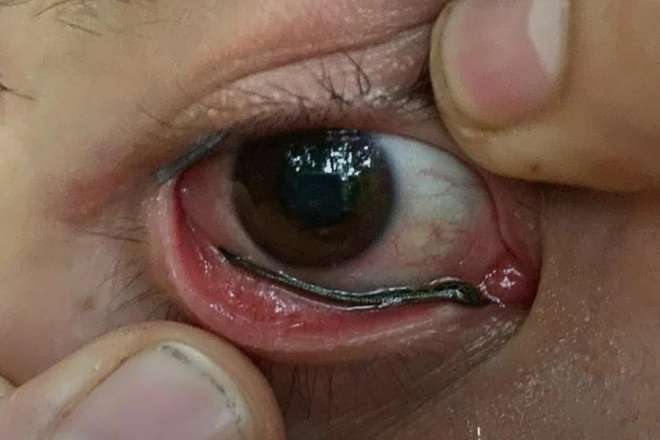 NGERI: Seekor lintah kelihatan memasuki kelopak mata bawah seorang pendaki di Thailand.