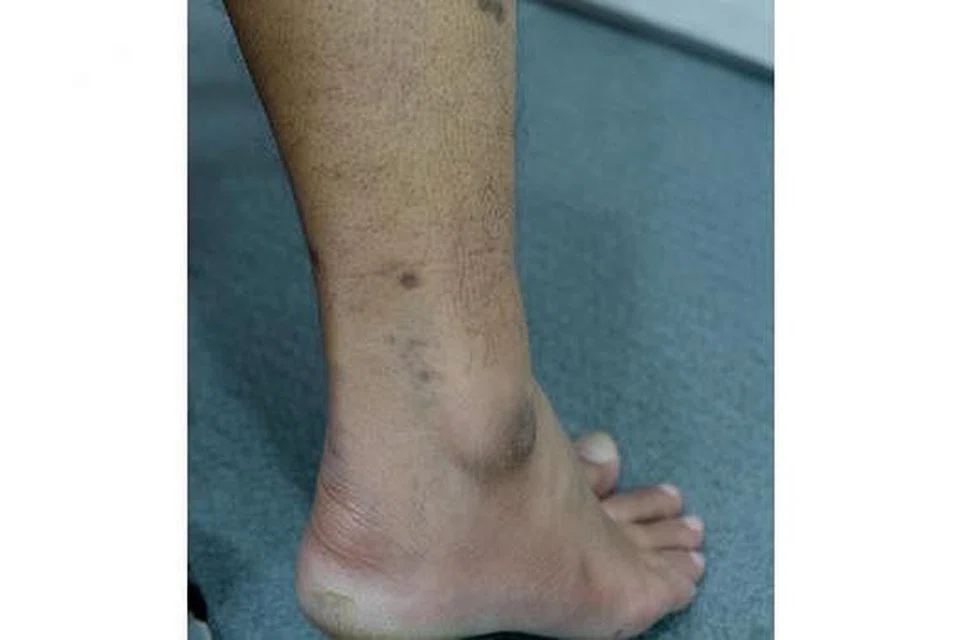 Gambar menunjukkan kesan parut yang masih ada pada kaki kanannya akibat penyakit kayap ular.