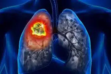 Pneumonia atau radang paru-paru menjadi sebab kematian utama di Malaysia pada 2023.