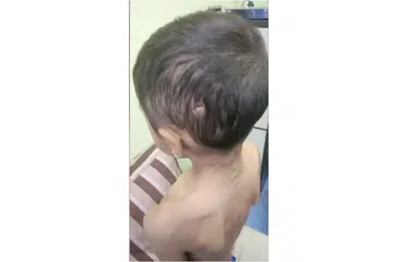 LARI RUMAH: Kesan kecederaan yang dialami kanak-kanak lelaki berusia enam tahun yang dipercayai telah didera oleh bapa kandung serta ibu tiri sendiri sejak Mac lalu, di Bahau.