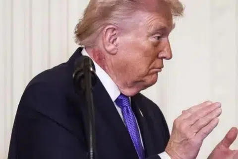 Presiden Donald Trump dilihat mengalami ruam merah di bahagian kanan lehernya.