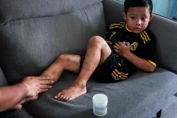 Faris Zafran, lima tahun, disyorkan agar menggunakan ubat ‘Dupixent’ apabila dia dirawat di hospital bagi menangani keadaan ekzemanya yang teruk, dengan luka bernanah di kaki.