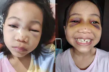 Gambar menunjukkan keadaan muka Fareen Airis sehari selepas insiden yang didakwa berlaku dalam bas sekolah.
