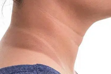 Kulit gelap di bahagian leher sering dialami ibu semasa kehamilan.