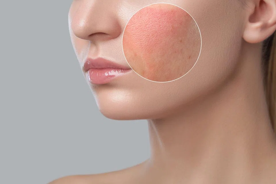 Salah satu tanda paling umum untuk mengetahui sama ada serum yang anda gunakan sesuai atau tidak adalah apabila ada kesan gangguan berlebihan terhadap kulit selepas menggunakan serum tersebut.