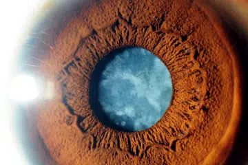 MATA MULA KABUR: Katarak ialah keadaan apabila kanta mata yang jernih menjadi keruh. Ini boleh diumpamakan seperti tingkap yang sebahagiannya diselaputi kotoran.