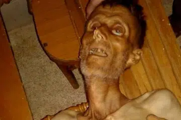 Seorang lelaki kurus kering tidak bermaya di Madaya dipapar dalam gambar tidak bertarikh yang diambil dariPADA media sosial ini. Gambar REUTERS