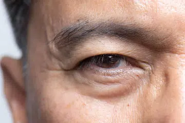 Kesihatan, masalah katarak mata