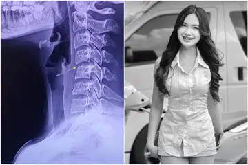 Penyanyi Thailand, Cik Phing Chyada, mendapatkan khidmat urut bagi melegakan sakit bahunya, namun mengalami kesakitan pada belakang leher diikuti dengan lengan kanannya menjadi lemah dan lumpuh separuh badan beberapa minggu kemudian. Kematiannya menjadi viral pada 8 Disember. 