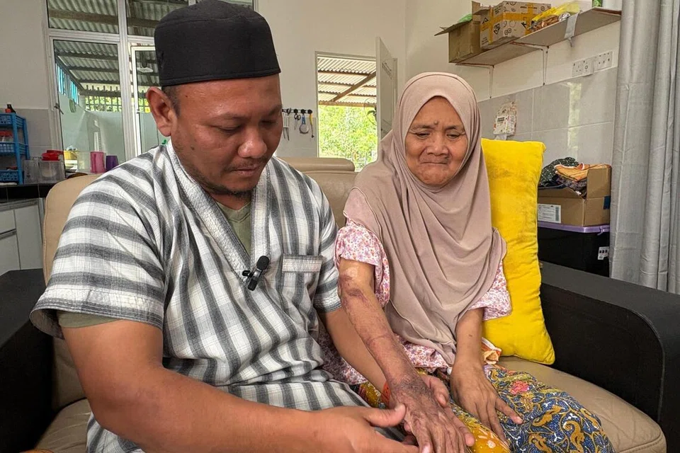 Encik Mohd Khairul Amin Mohd Rashid (kiri) menunjukkan kesan kecederaan melecur teruk yang dialami ibunya, Cik Yatimah Mohamad Nor, dalam kejadian letupan dan kebakaran dahsyat paip gas di Putra Heights, Subang Jaya, Selangor.