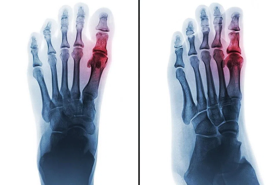 ANTARA PENYAKIT PALING LAMA: Gout adalah sejenis penyakit disebabkan berlebihan asid urik di dalam badan. Bagi penghidap gout, asid urik yang berlebihan tidak dibuang dan berkumpul di dalam sendi. - Foto ISTOCKPHOTO