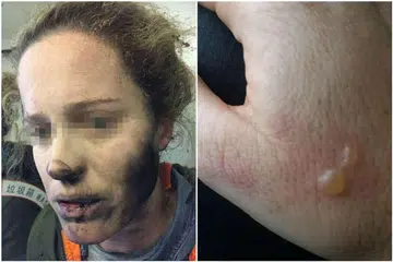 Muka dan leher wanita itu kehitaman dek terbakar sementara tangannya melepuh. 