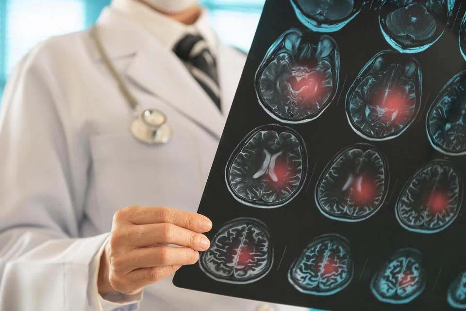 stroke, strok, kesihatan, serebrovaskular 