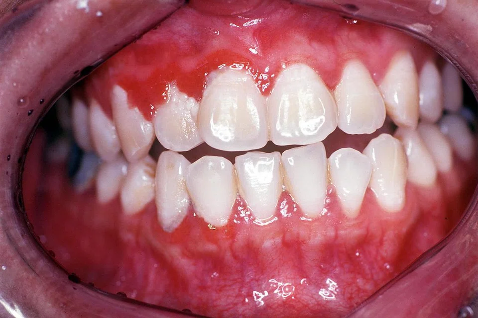 Gingivitis adalah keradangan gusi menyebabkan ia bengkak dan berdarah. Ia boleh dikesan dengan gejala kemerahan, atau kelembutan pada tisu gusi.