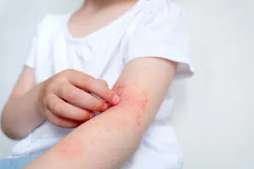 eczema, pregnant