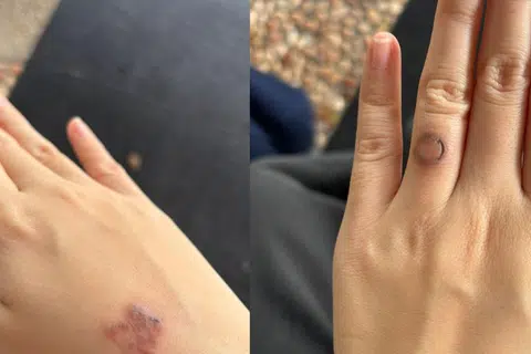 Tatu Cik Aleeya di tangan dan jari manisnya telah semakin pudar setelah menjalani dua sesi rawatan laser untuk membuang tatu.