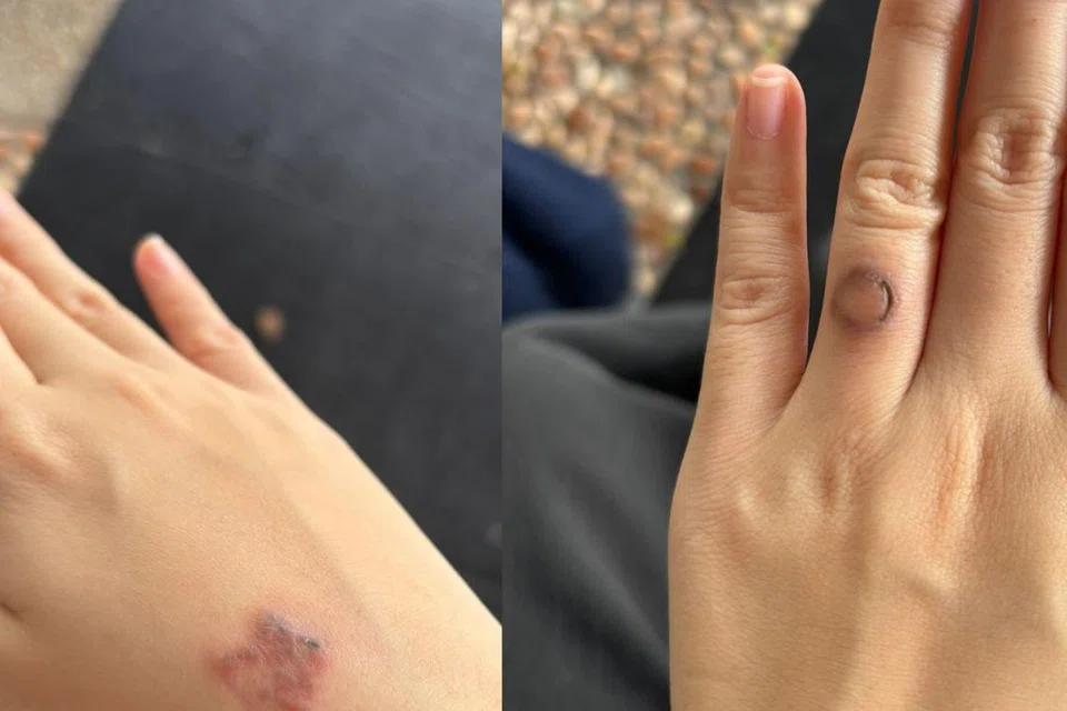 Tatu Cik Aleeya di tangan dan jari manisnya telah semakin pudar setelah menjalani dua sesi rawatan laser untuk membuang tatu.