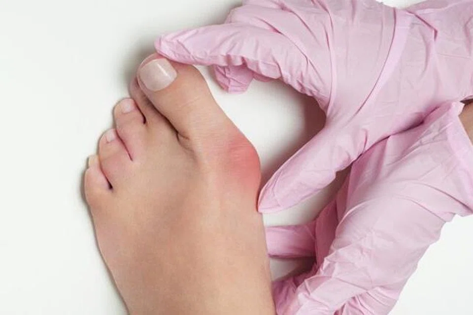 Jika memakai kasut yang tidak sesuai, bunion atau (bengkak pada sendiri pertama ibu jari kaki yang tersesar ke sisi boleh terjadi.