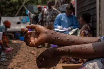 Seramai 46 daripada 5.2 juta pengembara ke Malaysia yang disaring telah disahkan negatif virus cacar monyet atau monkeypox (mpox).