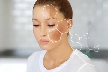 Melasma adalah pengumpulan pigmen pada kulit, sama ada pada lapisan epidermis (lapisan atas kulit), dermis (lapisan bawah kulit), atau kedua-duanya.