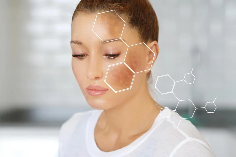 Melasma adalah pengumpulan pigmen pada kulit, sama ada pada lapisan epidermis (lapisan atas kulit), dermis (lapisan bawah kulit), atau kedua-duanya.